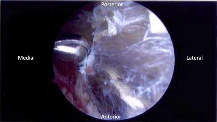 Arthroscopic view inside the scapulothoracic bursa during bursectomy.