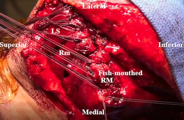 Posterior operative view after levator scapulae and rhomboid transfer with a split rhomboid-major attachment.
