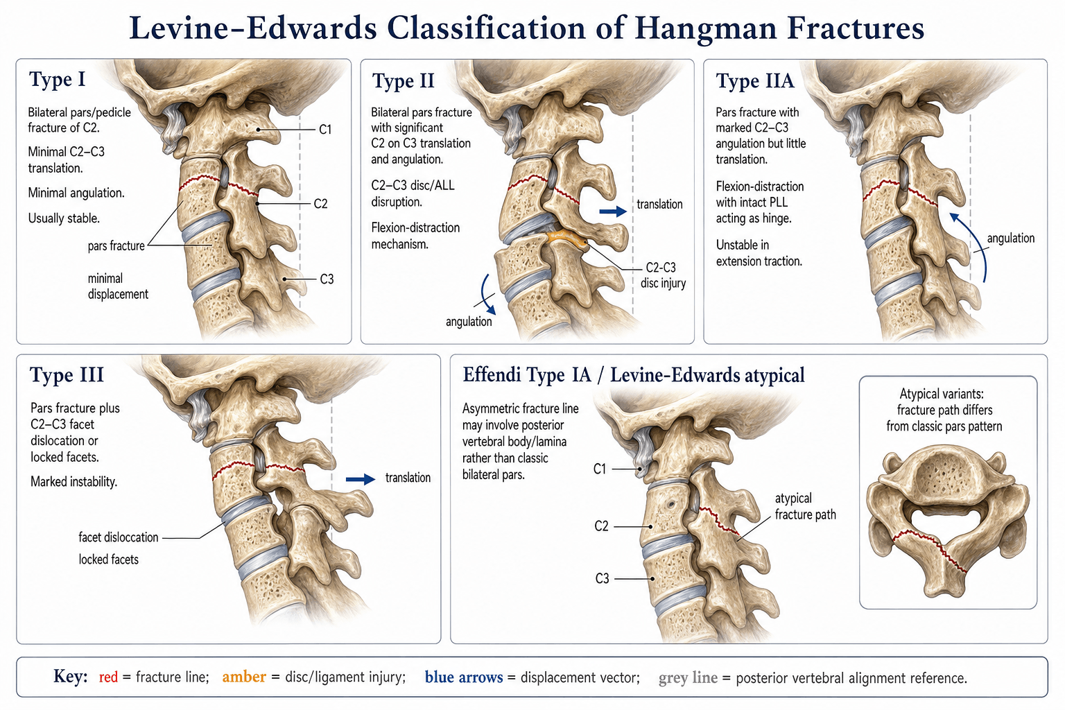 Levine-Edwards Classification of Hangman Fractures