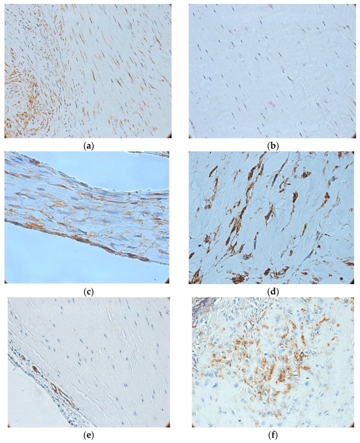 Immunohistochemistry of injured ACL remnants showing fibrosis, vimentin-positive cells and actin-positive myofibroblasts