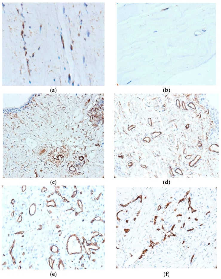 Histology of altered ACL and synovium showing CD34-positive fibrocytes and small blood vessels