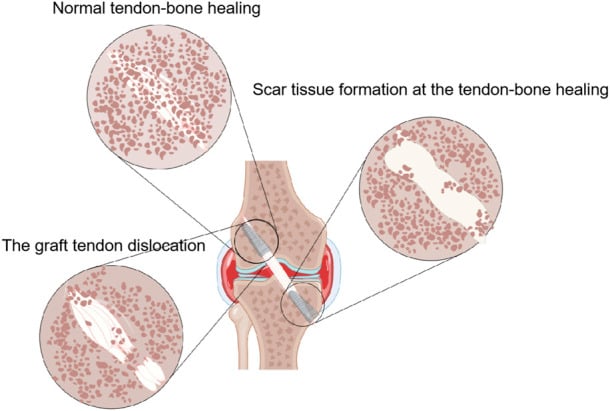 Diagram comparing normal tendon-bone integration with scar interface formation and failed graft incorporation