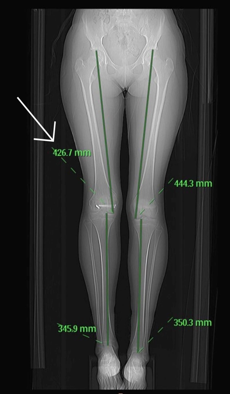 CT scannogram of both lower limbs used to quantify paediatric limb length discrepancy