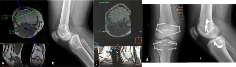 MRI and knee radiographs showing genu recurvatum after asymmetric guided-growth tethering
