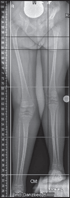 Child with marked limb length discrepancy on standing radiograph