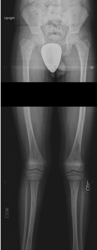 Standing full-length lower-limb radiograph for limb length and alignment assessment