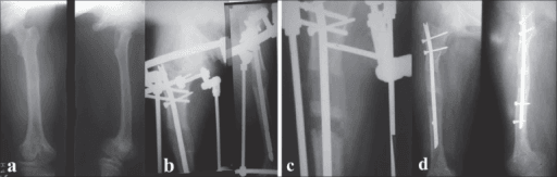 Serial radiographs of femoral lengthening over a nail (LON) for 12 cm post-growth-arrest shortening