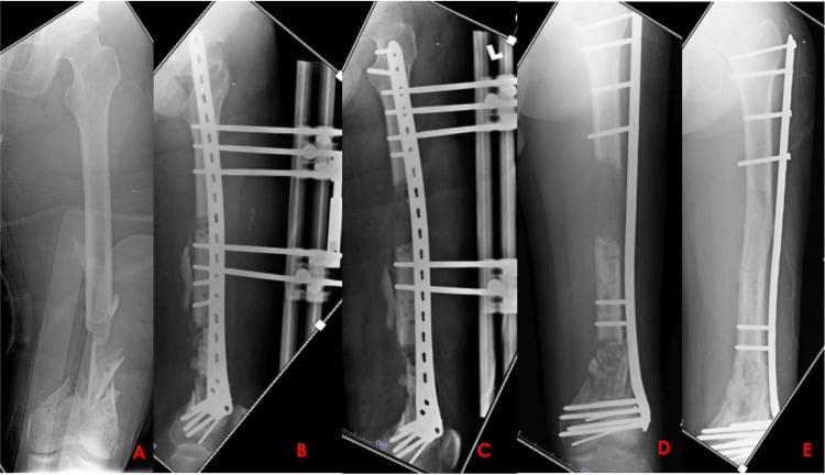 Serial radiographs of acute shortening followed by proximal lengthening over a plate for a segmental tibial defect
