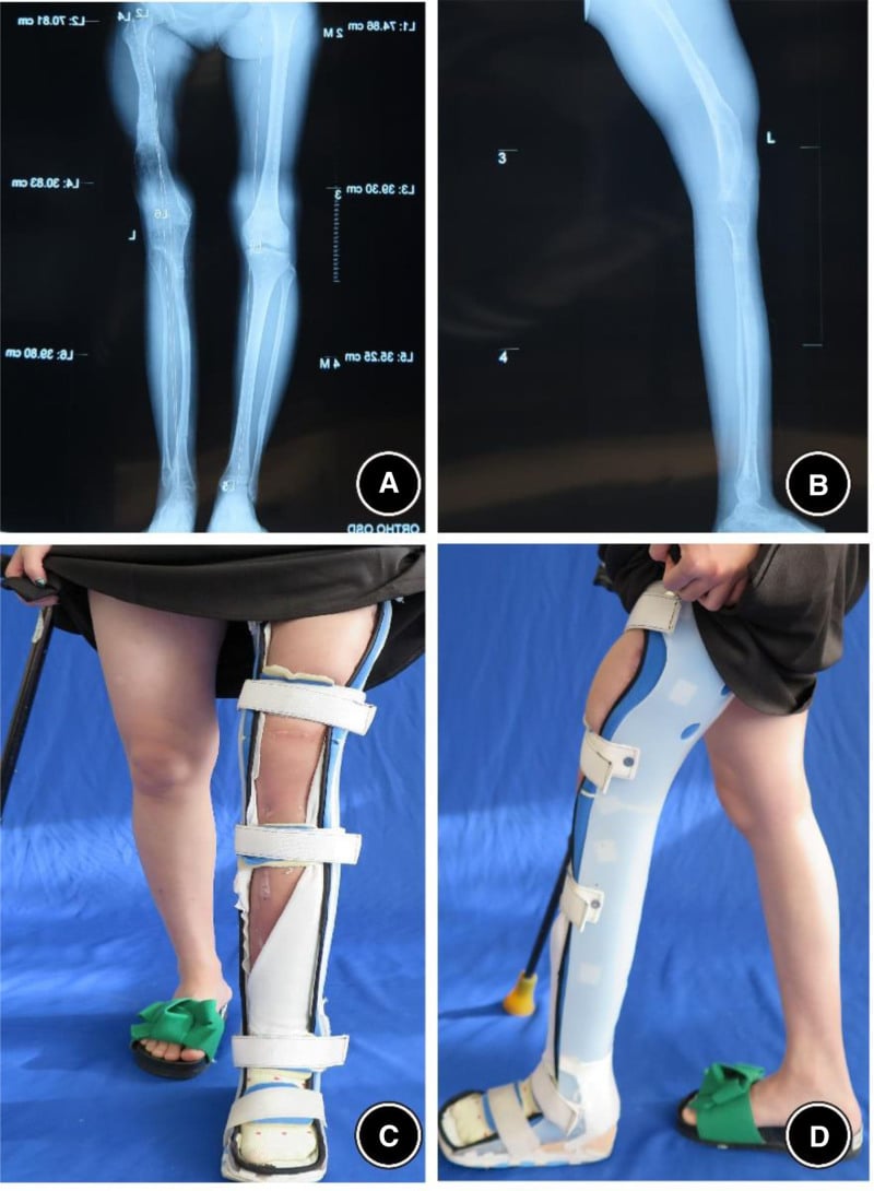 Standing radiographs after bilateral femoral and tibial lengthening showing consolidated regenerate and near-equal limb lengths