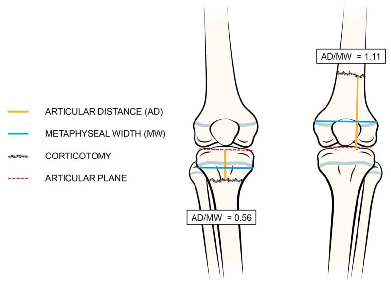 Diagram of articular-distance to metaphyseal-width measurement for selecting the corticotomy level