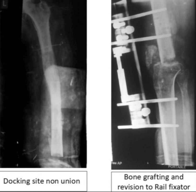 Radiographs of docking-site nonunion before and after grafting and rail fixation