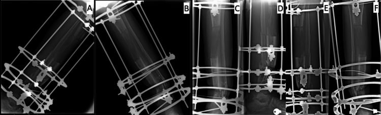 Serial AP and lateral radiographs showing completion of tibial bone transport and docking-site contact
