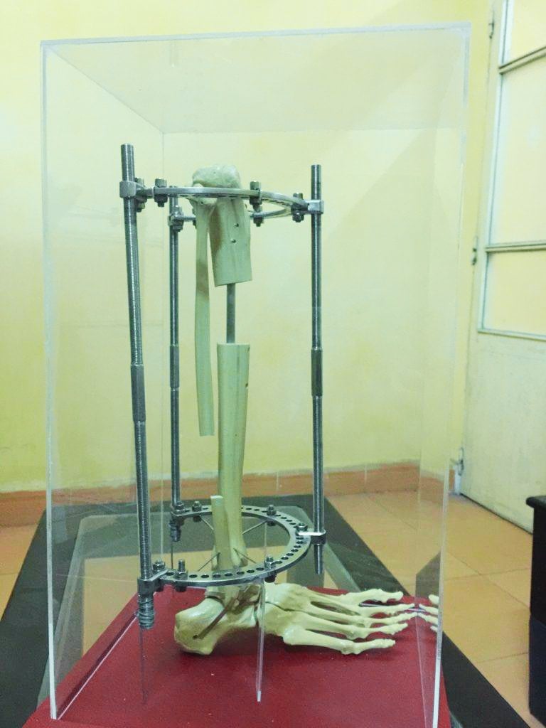 Anatomical teaching model of a tibia in a circular Ilizarov frame with a corticotomy gap