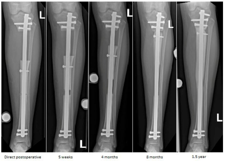 Sequential AP radiographs showing internal tibial bone transport from postoperative state to consolidation