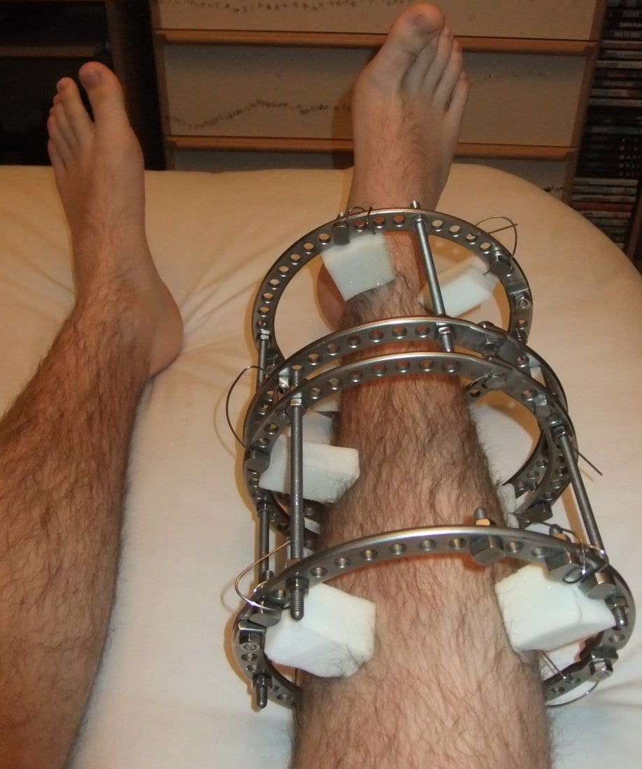 Ilizarov circular external fixator on the lower leg with rings, tensioned wires and pin-site dressings