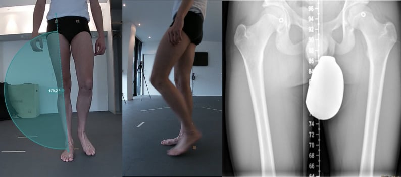 Clinical and radiographic mechanical-axis assessment using standing alignment and hip-centre localisation
