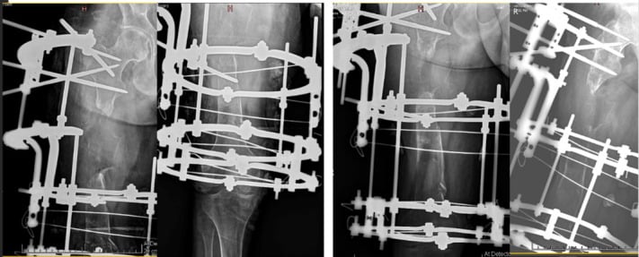 Serial femoral radiographs showing poor regenerate after Ilizarov-assisted distraction osteogenesis