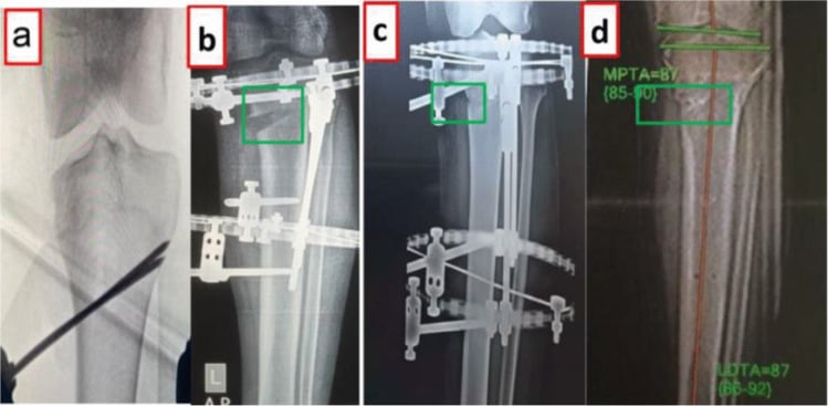 Two-stage schematic of drill-hole and osteotome proximal tibial corticotomy followed by gradual distraction