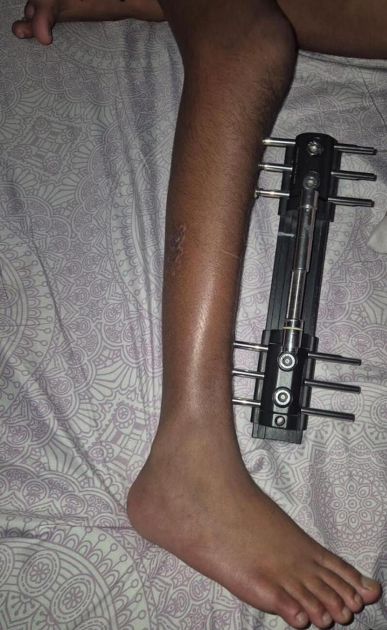 Clinical photograph of a tibial monolateral rail fixator used for limb lengthening