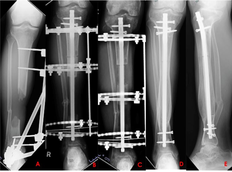 Serial tibial radiographs showing bone transport over an intramedullary nail