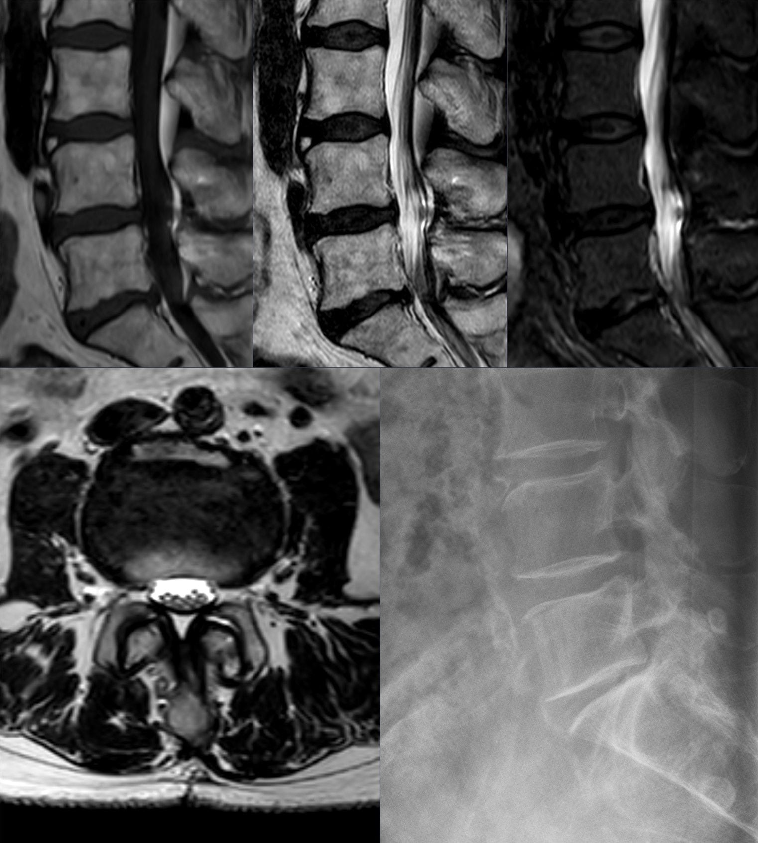 MRI and lateral radiograph of a limbus vertebra showing a triangular bony fragment separated from the anterior corner of a lumbar vertebral body.