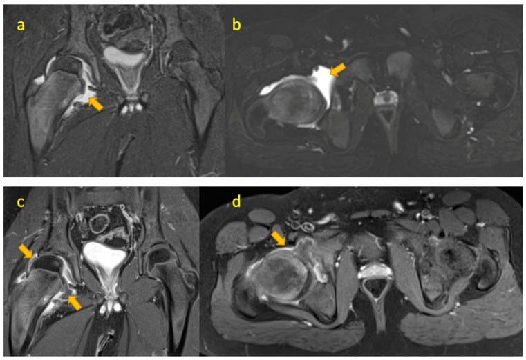 Coronal and axial fluid-sensitive and post-contrast MRI showing a large hip effusion and diffuse synovitis in juvenile inflammatory arthritis