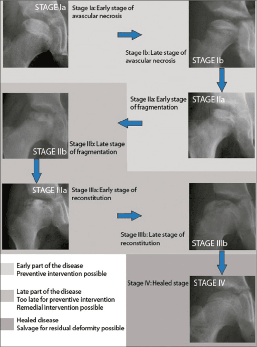 Perthes disease stage reference image relevant to the limping child differential