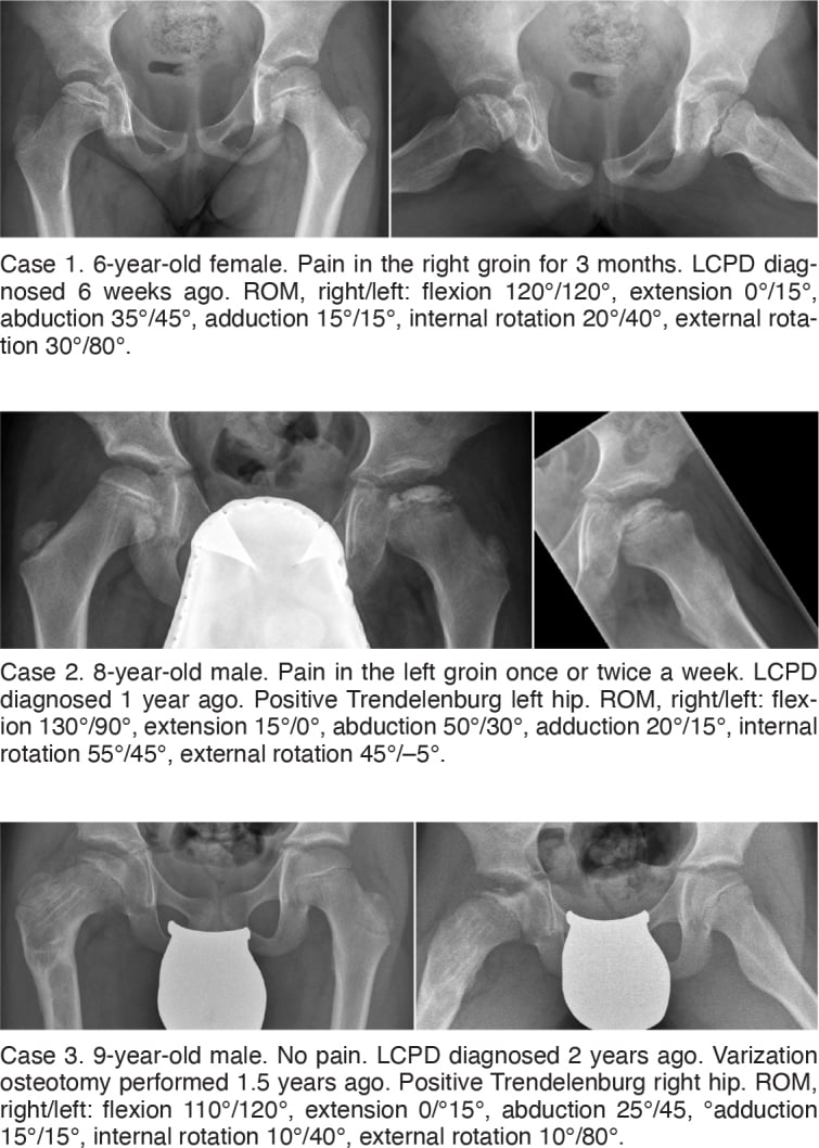 Serial frontal and frog-leg lateral hip radiographs illustrating initial, fragmentation and re-ossification stages of Perthes disease