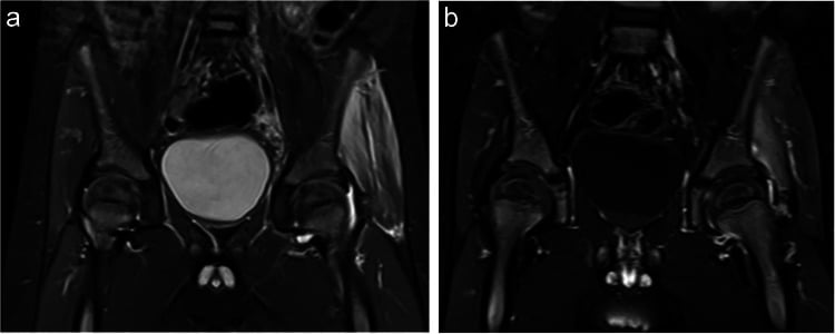 Coronal STIR and post-contrast fat-suppressed T1 MRI showing septic hip effusion with marked gluteal muscle oedema and enhancement