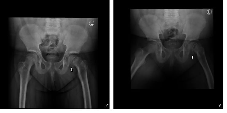 AP pelvis and frog-leg lateral radiographs showing a left slipped upper femoral epiphysis