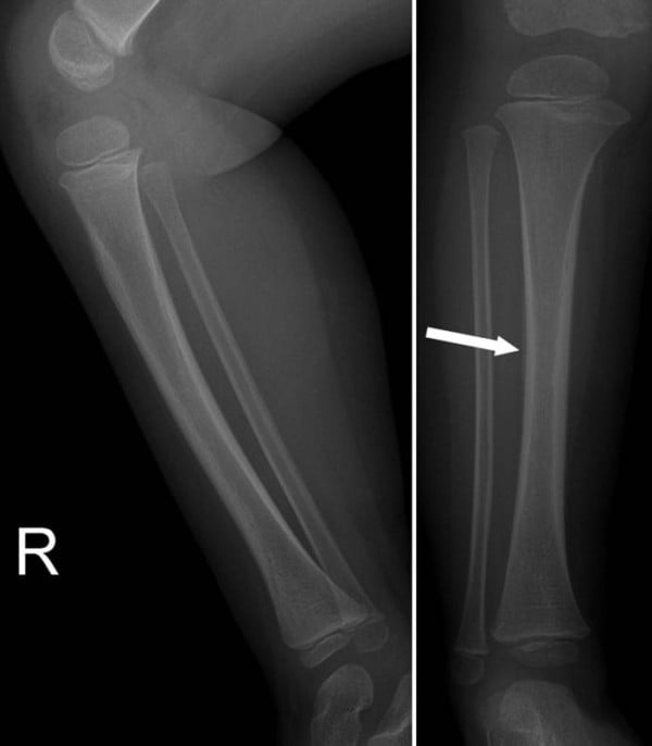 Follow-up AP and lateral tibial radiographs showing periosteal new bone formation around a healing toddler fracture