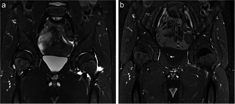 Coronal STIR and post-contrast fat-suppressed T1 MRI showing a large unilateral hip effusion in a child with transient synovitis
