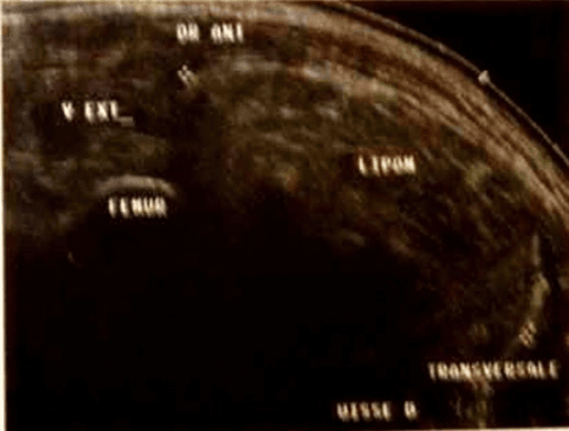Ultrasound of deep thigh lipoma adjacent to femur