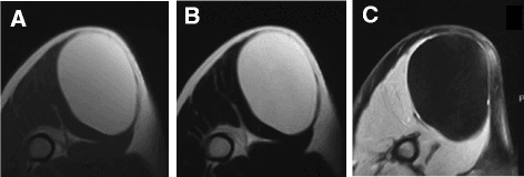 Three-panel axial MRI of a 12 cm intramuscular lipoma: a homogeneously fat-signal mass that is high on T1 and T2 and suppresses on fat-saturated gadolinium-enhanced imaging without nodular enhancement.