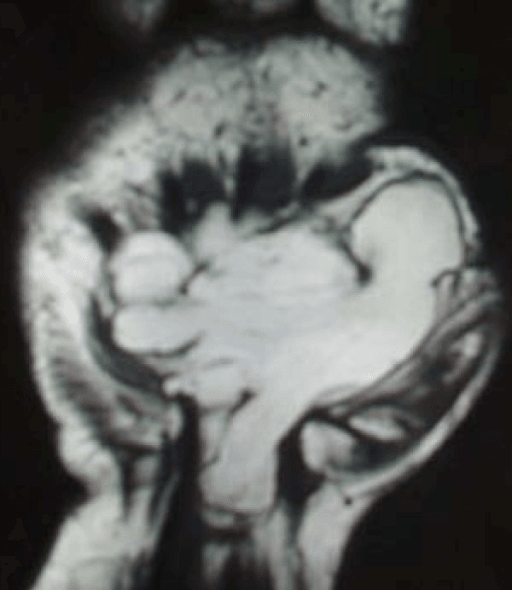 MRI of giant palmar lipoma invading carpal tunnel