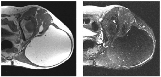Axial T1 and T2 MRIs of a patient with a large fatty tumor in the buttock. Despite the large size and intratumoral stranding/nodularity, final pathological review confirmed a diagnosis of lipoma.