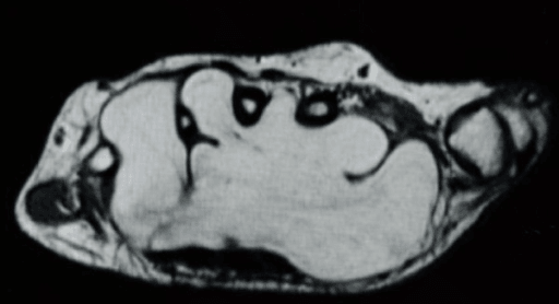 MRI of hand lipoma extending into web spaces
