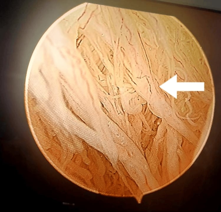 Arthroscopic view of frond-like fatty villous synovial proliferations in lipoma arborescens