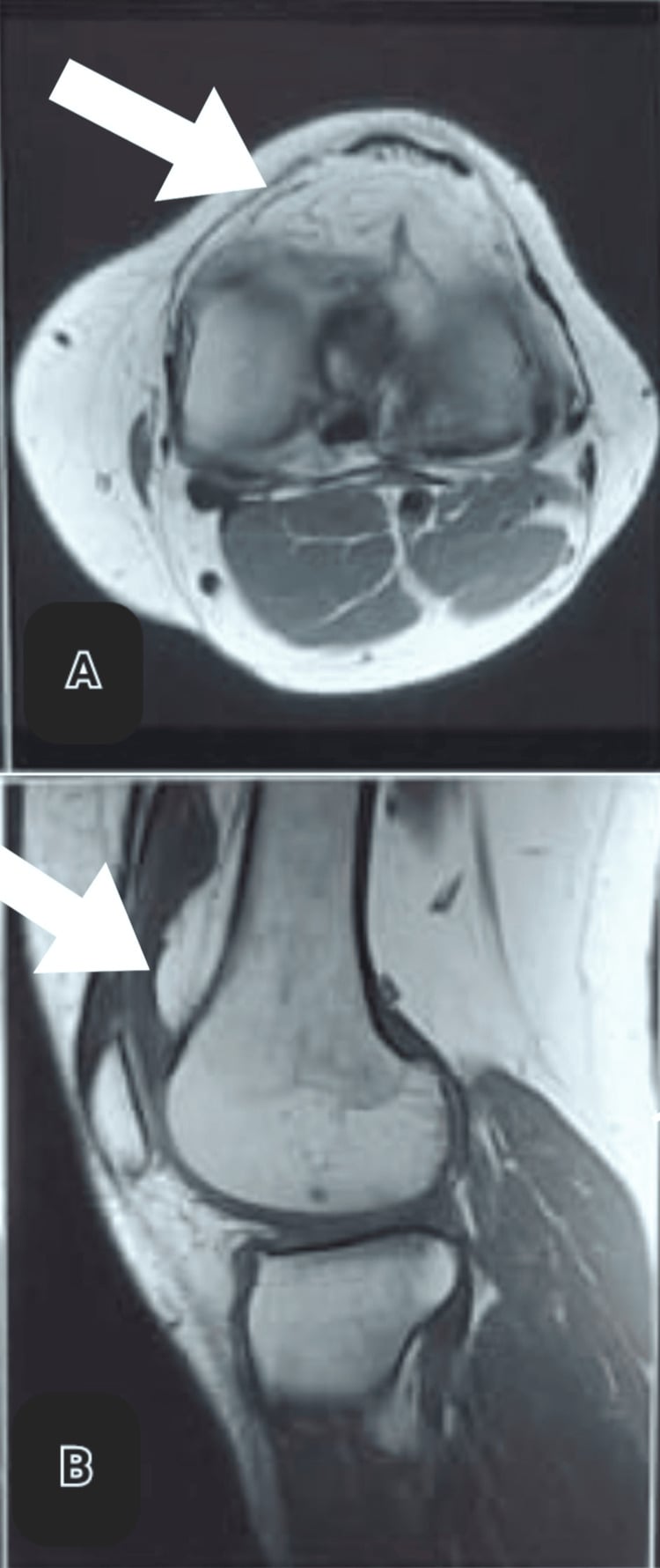 Axial and sagittal MRI of the knee showing the frond-like arborescent synovial mass of lipoma arborescens