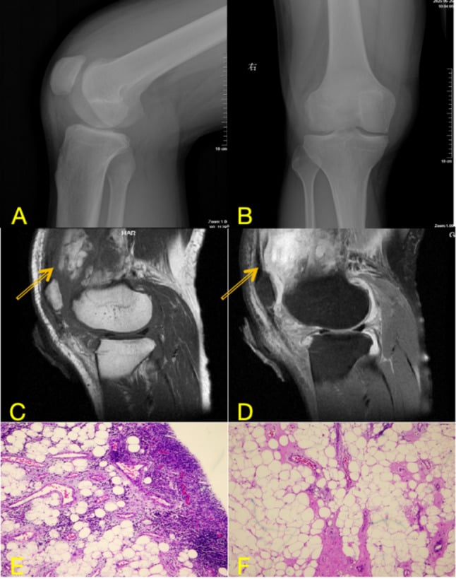 Preoperative knee radiographs and sagittal T2 MRI demonstrating lipoma arborescens mass