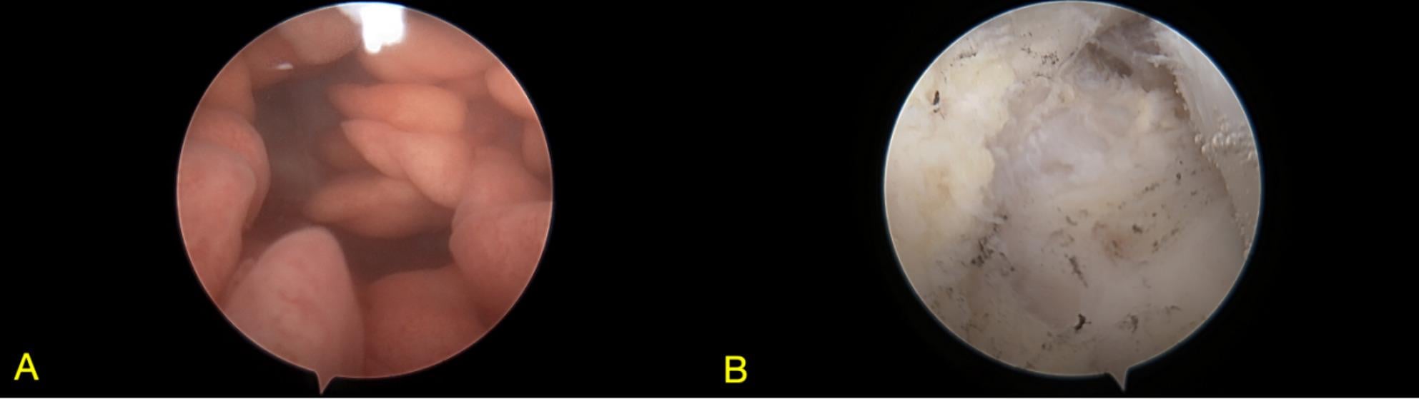 Intraoperative arthroscopy photographs before and after synovectomy in lipoma arborescens