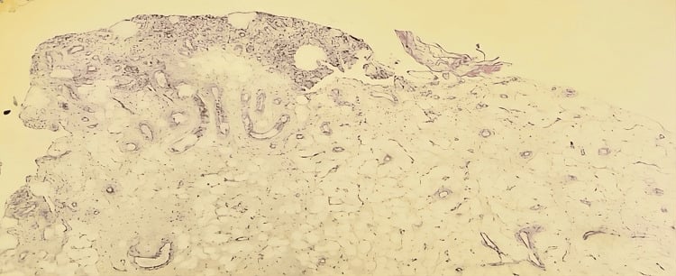 Histopathological H&E photomicrograph of synovial lining with mature adipocyte infiltration
