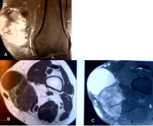 Myxoid liposarcoma of thigh on MRI
