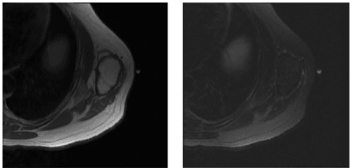 Low-grade liposarcoma on MRI mimicking lipoma