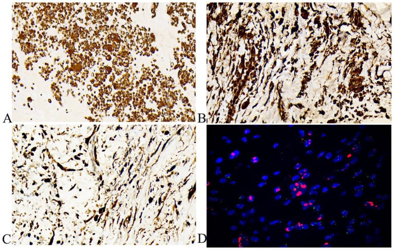 Immunohistochemistry and fluorescence in situ hybridisation panels from dedifferentiated liposarcoma.