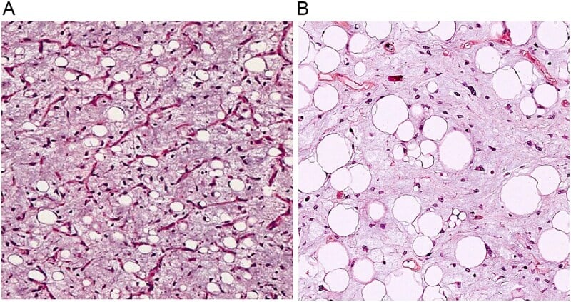 H&E histology panels showing myxoid stroma, lipoblasts and atypical cells in myxoid liposarcoma.