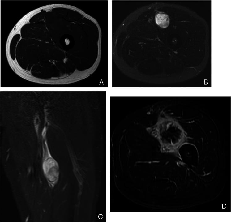 Axial MRI panels showing a myxoid pleomorphic liposarcoma in the thigh.