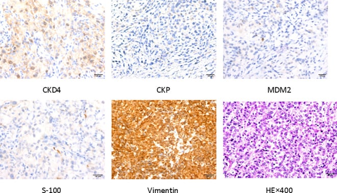 Immunohistochemical and H&E panels from pleomorphic liposarcoma.