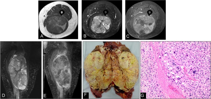 MRI, gross specimen and histology panels of pleomorphic liposarcoma.