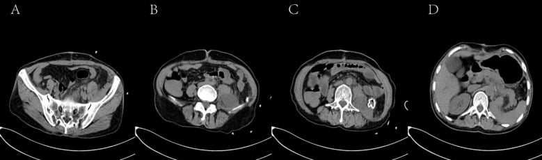 Axial postoperative CT levels used to surveil the abdomen after liposarcoma resection.